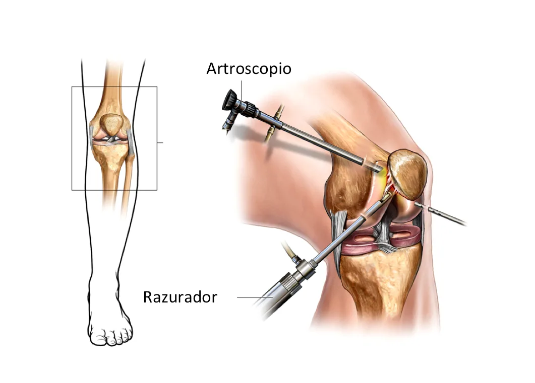 Artroscopia de rodilla: artroscopio y razurador dentro de la articulación