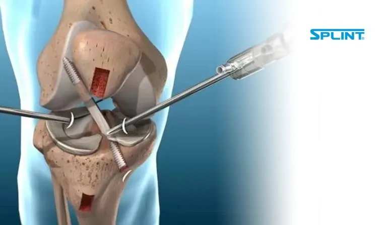 Artroscopia de Rodilla